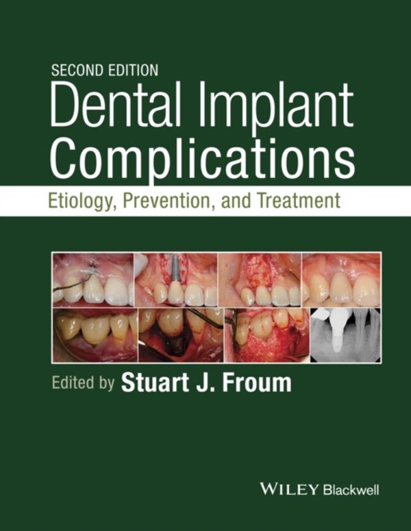 Cover Art for 9781118976456, Dental Implant ComplicationsEtiology, Prevention, and Treatment by Stuart J. Froum