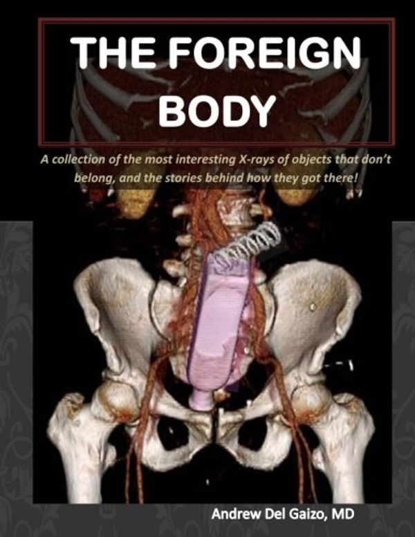 Cover Art for 9781482618167, The Foreign Body: A collection of the most interesting X-rays of things that don't belong and the stories behind how they got there! by Del Gaizo M.D., Andrew